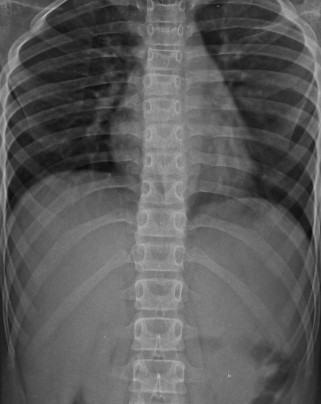 DORSAL SPINE X-RAY AP/LAT