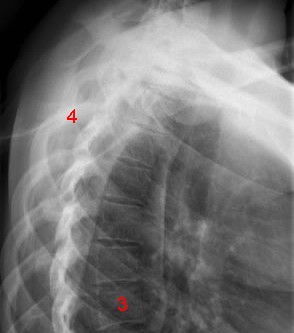 DORSAL SPINE X-RAY LAT
