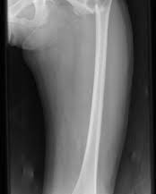 FEMUR X-RAY AP/LAT