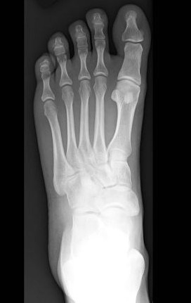 FOOT X-RAY (RT/LT) AP