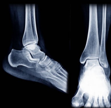FOOT X-RAY AP/ LAT