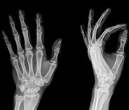 HAND X-RAY (RT/LT) AP