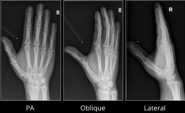 HAND X-RAY (RT/LT) LAT
