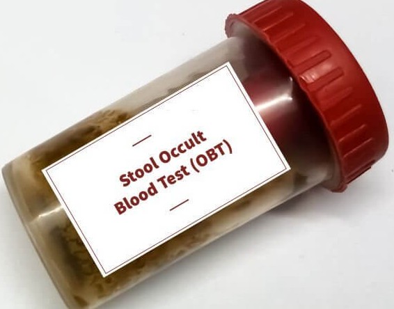 OCCULT BLOOD TEST (OBT)