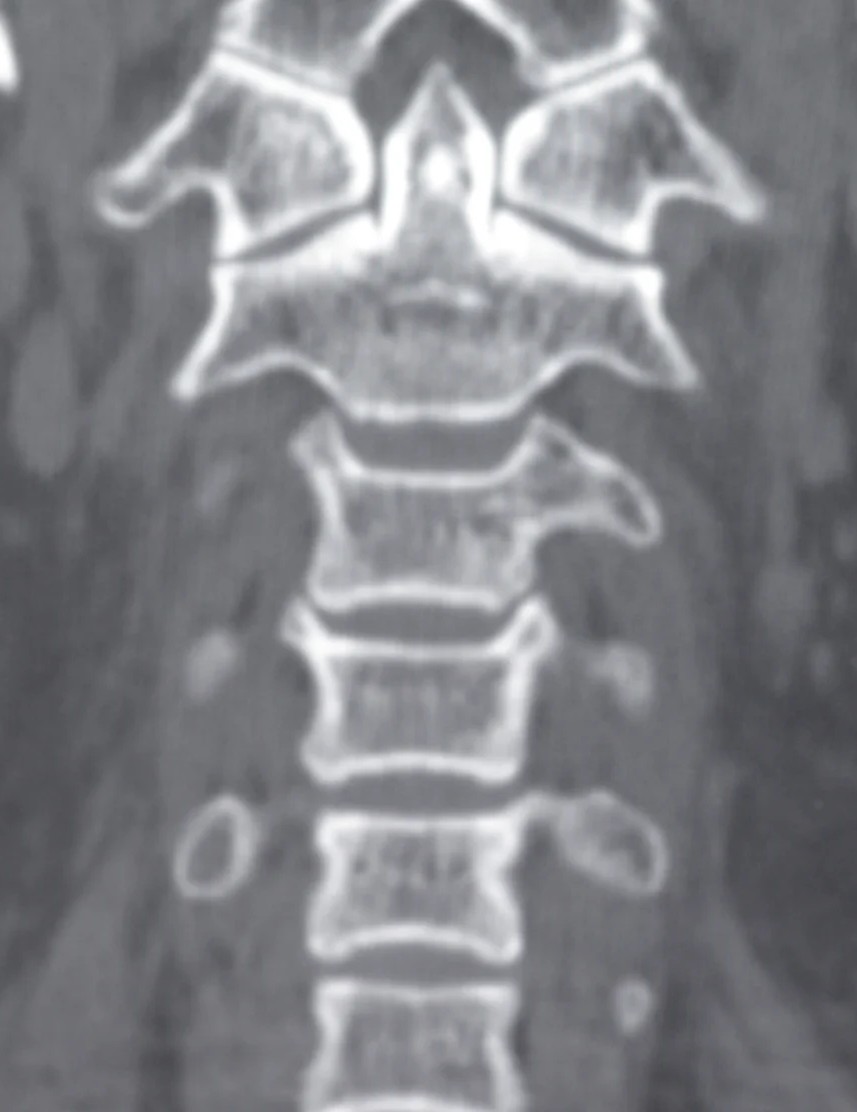 CERVICAL SPINE