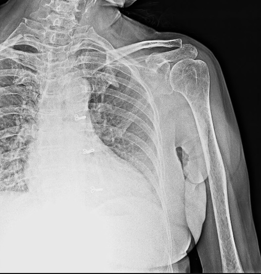 X-RAY RT SHOULDER AP/LAT