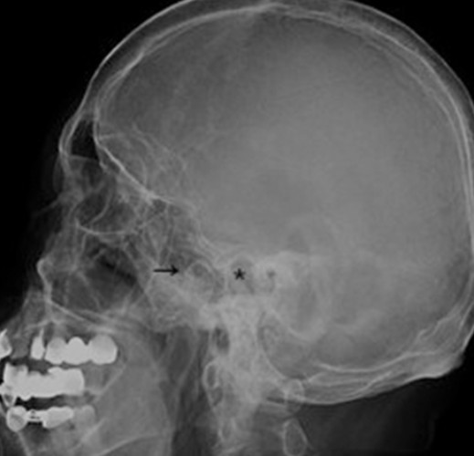 X-RAY RT MASTOID LAT-OBL