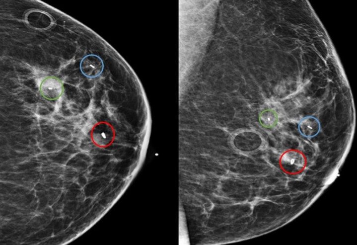 CA 15.3 (BREAST CANCER MARKER)