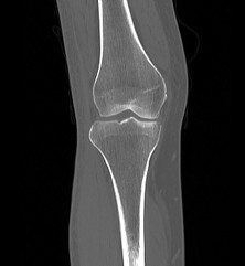 CT Scan Both Knee