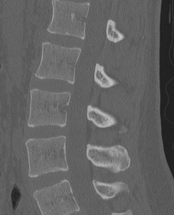 CT SCAN DORSAL SPINE