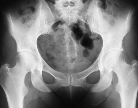 BOTH HIP X-RAY AP/ LAT