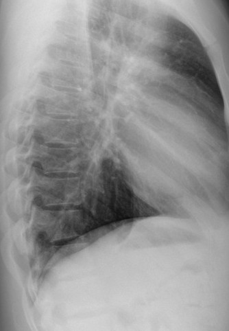 CHEST X-RAY LAT VIEW